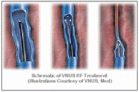 VNUS