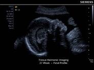 Siemens X150fetal profile