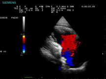 Siemens Acuson P300 Heart Image