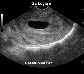 GE Logiq e Gestational Sac