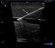 Ultrasound needle guidance image