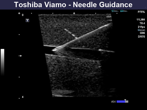 Viamo Needle Guidance