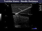 Ultrasound with needle guidance