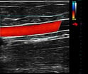 Ultrasound Focal Position