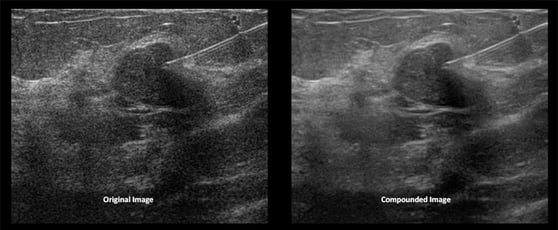 ultrasound-needle-guidance-compounded-image.jpg