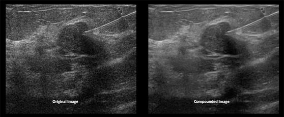 ultrasound-needle-guidance-compounded-image.jpg